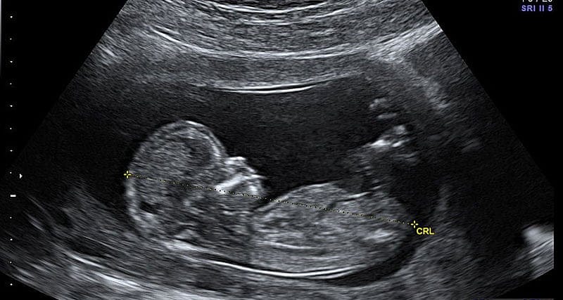 Charlie Baker Backs Increasing Taxpayer Funding Of Abortion By Millions