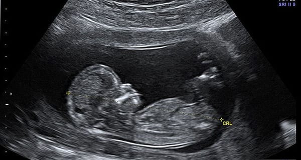 UMass Poll Finds Majority Of Americans O.K. With Abortion Being Banned In At Least Some States