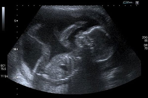 Trump Administration:  Abortion for Raped Illegal Immigrant Teen-Ager Would Be ‘Further Violence’