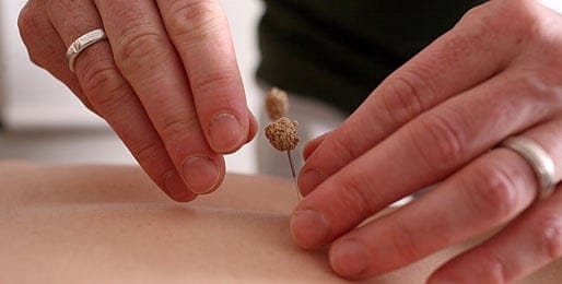 Demystifying the art and healing power of acupuncture