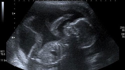 Abortion Supporters Disturbed By ‘Irresponsible and Harmful’ Story On 40 Days For Life